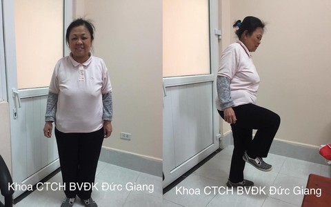 Mặt tích nước, loãng xương do hậu quả việc tự ý dùng thuốc corticoid suốt 20 năm
