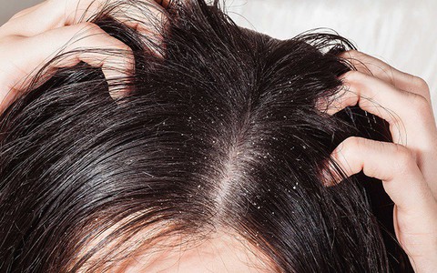 Xử lý khi bị nấm da đầu, tránh khó chịu, ngứa ngáy, mất tự tin vào mùa hè
