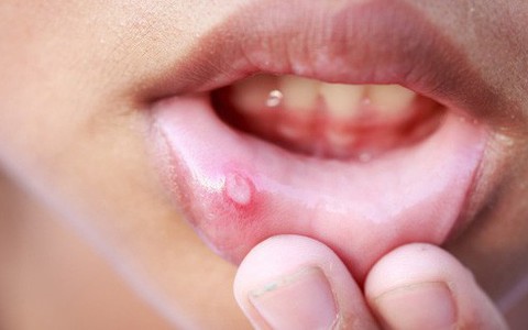 7 triệu chứng thường gặp của bệnh ung thư miệng mà nhiều người hay nhầm lẫn
