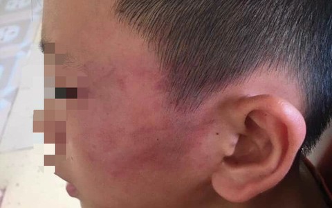 Nghệ An: Nghi án bé trai 12 tuổi bị mẹ kế đánh thương tích đầy mình phải nhập viện