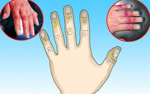 Bỏng lạnh cực nguy hiểm nếu không được sơ cứu đúng cách nhưng mọi người vẫn chưa nâng cao cảnh giác