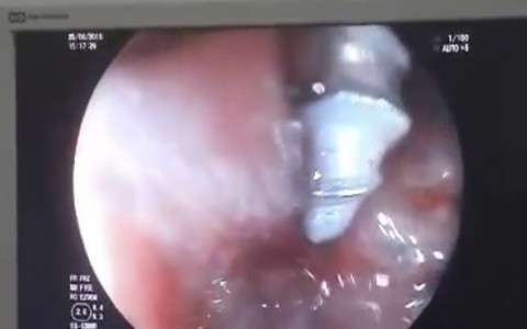 Thấy con gái quấy khóc liên tục, mẹ đưa đi cấp cứu thì phát hiện bé nuốt đinh xoắn ốc vào bụng