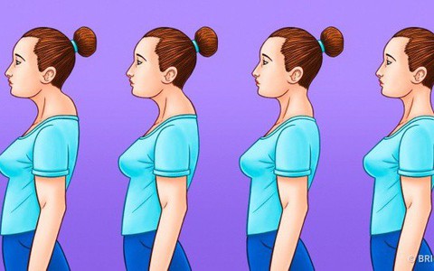 Nếu bạn quá buồn lòng vì bỗng nhiên dáng xấu đi do vai u, lưng còng, có bướu sau gáy thì hãy làm ngay 6 điều này