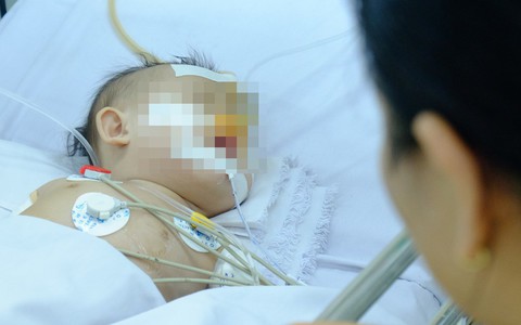 Uống nhầm nước tro tàu làm bánh ú, bé gái 3 tuổi bị bỏng thực quản