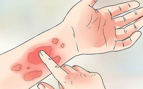 Ngứa da điên cuồng trong mùa hè, có thể là do bạn đã mắc phải một trong các bệnh sau