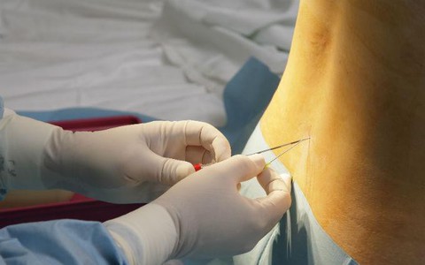 Tất tật những điều các mẹ cần biết về mũi gây tê ngoài màng cứng - phương pháp giảm đau khi sinh nở