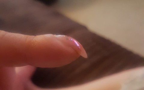 Thấy móng tay có hình dáng kì lạ, người phụ nữ đi khám thì biết mình bị bệnh ung thư phổi: Dấu hiệu ở móng tay cảnh báo bệnh