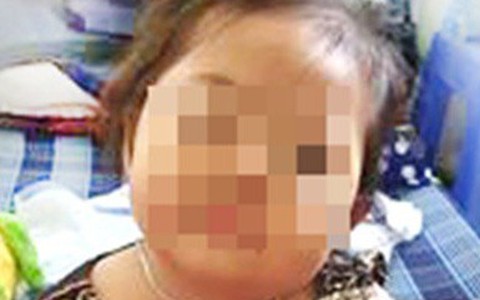 Tiêm ngừa bị nhiễm trùng, bé gái 32 tháng tuổi phải phẫu thuật đùi trái 3 lần