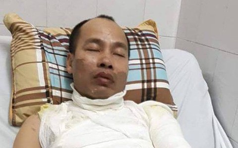 Hà Nội: Con gái 9 tuổi hoảng loạn chứng kiến cảnh bố bị tạt axit ngay trước mặt