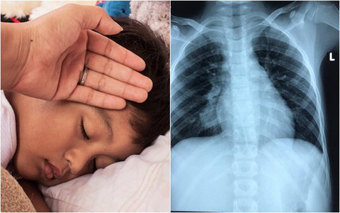 Tưởng là lao phổi nhưng khi chụp CT, bác sĩ phát hiện bé 11 tuổi suýt tử vong vì căn bệnh hiếm gặp