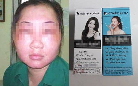 Dùng "mỹ phẩm dân tộc” mong da đẹp "lột xác", cô gái 19 tuổi bị biến dạng cả mặt, mắt híp lại và sưng vù kinh dị