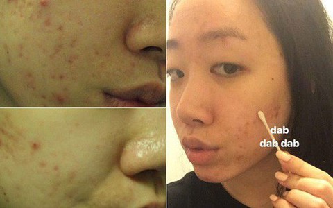 Mặt đầy mụn sưng đỏ, cô nàng này đã thay đổi rõ rệt sau khi thử dùng dầu tràm trà trong 1 tuần