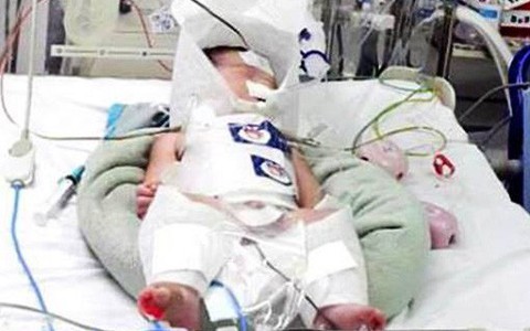 Đang chuyển dạ, sản phụ bất ngờ đau vật vã, bác sĩ vội vã mổ cấp cứu thấy máu tràn khắp ổ bụng