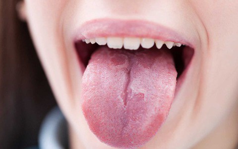 Những triệu chứng bất thường ở lưỡi có thể cảnh báo bạn đang mắc các căn bệnh nguy hiểm