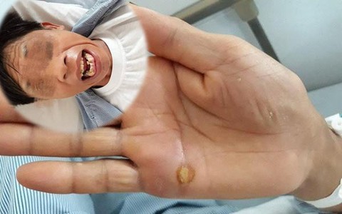 Chỉ vì bị dằm đâm vào tay mà người đàn ông bị cứng hàm, thậm chí suýt mất mạng và lời cảnh báo không thừa cho bất cứ ai