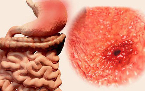 7 triệu chứng ung thư sớm không gây đau: Chỉ cần có 1 triệu chứng là bạn phải đi khám ngay