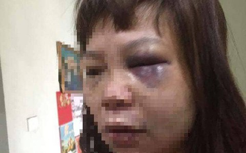 Vì ghen tuông, nữ hộ lý bị chồng dụ lên đồi đánh đập dã man, cắt gân chân