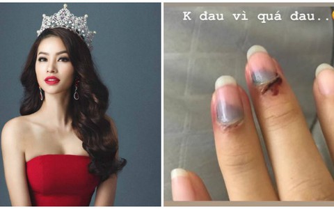 Phạm Hương bất ngờ đăng tải hình ảnh các ngón tay bị bầm dập khiến fan "sốt xình xịch" vì lo lắng