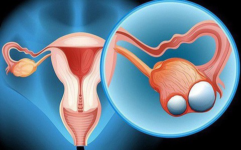 Vẫn sống khỏe dù bị ung thư buồng trứng, đây là điều mà người phụ nữ 30 tuổi không may mắn này muốn chị em hãy ghi nhớ