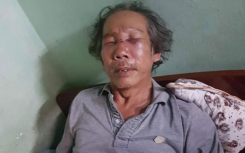 Bảo vệ chung cư Sài Gòn đánh ông già 68 tuổi rách mặt, gãy sống mũi vì đậu xe sai quy định