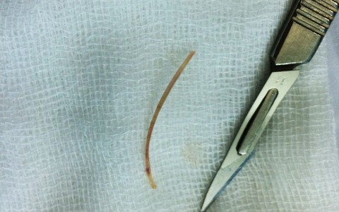 TP.HCM: Cụ bà 77 tuổi bị thủng ruột vì ăn cá ‘quên’ nhả xương