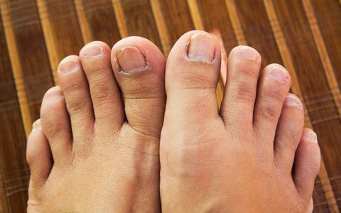 Những hiện tượng kinh khủng này có thể xuất hiện khiến sức khỏe bàn chân của bạn thêm tồi tệ