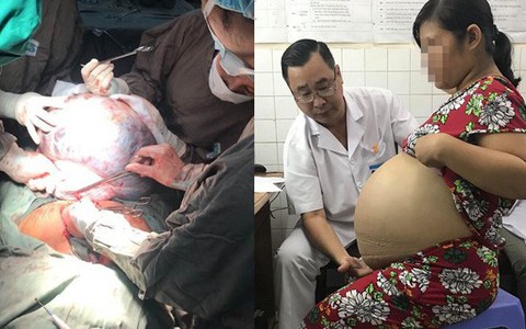 Từ 1 khối u nhỏ bị "bỏ quên" trong tử cung, 4 năm sau, người phụ nữ khổ sở vì khối u lớn "khủng khiếp"