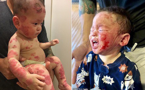 Bôi thuốc để chữa bệnh chàm cho con, cha mẹ kinh hoàng khi thấy toàn thân bé bị lở loét, rỉ nước đến biến dạng