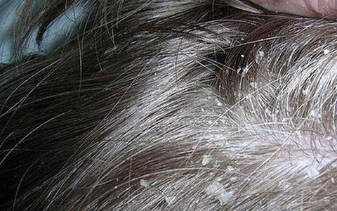 Những nguyên nhân không ngờ gây ra tình trạng nấm da đầu mà nhiều người không hề nghĩ tới