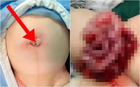 Thấy con phình rốn, cặp vợ chồng thiếu hiểu biết vô tư dùng dao rọc giấy "phẫu thuật" gây ra cảnh tượng rùng mình