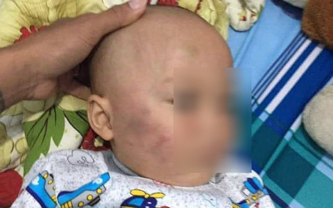 Vĩnh Long: Bé trai 19 tháng tuổi bị bảo mẫu tát liên tục vào mặt, phải nhập viện điều trị