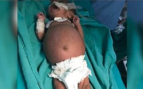 Bé gái sinh ra với chiếc bụng sưng to bất thường, vài ngày sau vẫn không thuyên giảm, nhập viện thì bác sĩ mổ ra đứa trẻ thứ 2
