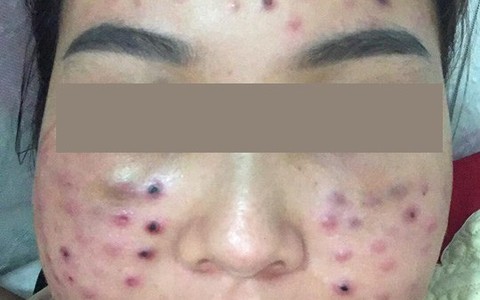 Tiêm căng bóng da tại một spa cỏ, cô gái nhận cái kết cay đắng với tình trạng mặt thâm rỗ như tổ ong