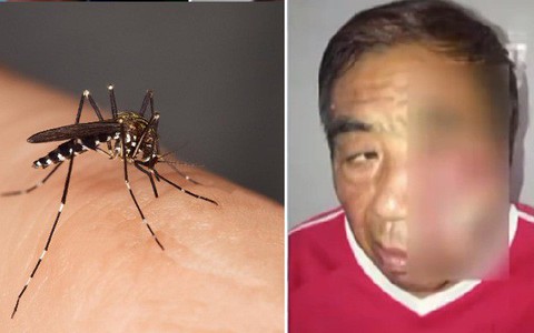 Đêm ngủ bị muỗi đốt, chỉ vì làm việc này mà người đàn ông bị nhiễm trùng, hoại tử tận xương, suýt mất mạng