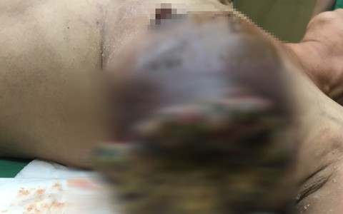 Hãi hùng cảnh ngực người phụ nữ bị lở loét, hoại tử nặng nề vì tự tiện dùng lá thuốc đắp trị ung thư
