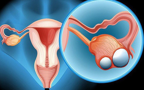 Cô gái 23 tuổi chưa kết hôn đã bị ung thư dạ dày di căn buồng trứng, cảnh báo những thói quen xấu nhiều người mắc