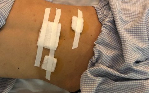 Đau tức bẹn bìu, phải nhập viện phẫu thuật: Khuyến cáo của bác sĩ dành cho người thường xuyên phải đứng làm việc hoặc lao động nặng