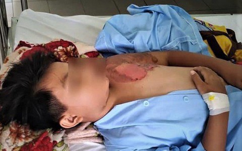 Hoàn cảnh vô cùng bi đát của bé trai nghi bị cha ruột tạt nước sôi gây bỏng nặng