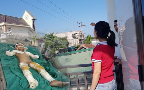 Đứng ở tầng 2, nam sinh lớp 7 bị dây điện trần phóng điện làm cụt 2 cánh tay
