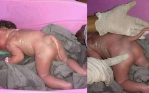 Thực hư chuyện em bé sinh ra có chiếc đuôi dài khiến không ít người xôn xao  