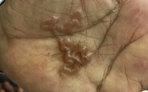 Loại giun sán khiến nhiều người dân ở Khánh Hòa phải nhập viện thực sự đáng sợ thế nào?
