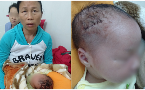 Nóng: Bệnh viện mổ bắt con khiến bé trai sơ sinh bị rách đầu, khâu 6 mũi, có biểu hiện sốt, co giật