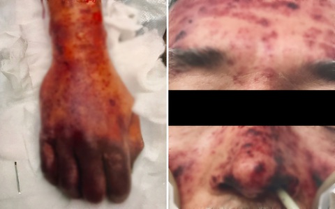 Sau khi bị chó cưng liếm, người đàn ông khỏe mạnh bị hoại tử toàn thân và phải trả giá bằng cả mạng sống 