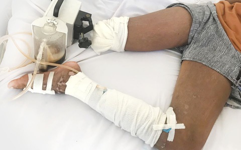 Con gái bị rắn cắn nhưng cha đưa đi thầy lang cắt lể chứ không đến bệnh viện khiến bé 13 tuổi phải cắt bỏ bàn chân phải