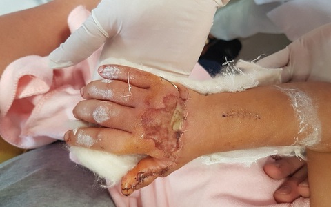 6 giờ đồng hồ căng thẳng, bằng phẫu thuật vi phẫu bác sĩ nối bàn tay phải đứt gần rời cho bé gái 3 tuổi