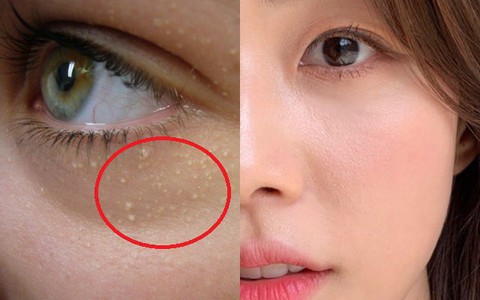 3 cách đơn giản giúp bạn loại bỏ tình trạng mụn thịt kém thẩm mỹ 