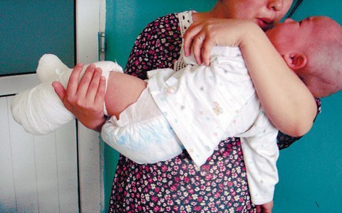 Bé 4 tuổi bị bỏng chảo dầu, cách sơ cứu của bà khiến bác sĩ khen ngợi hết lời