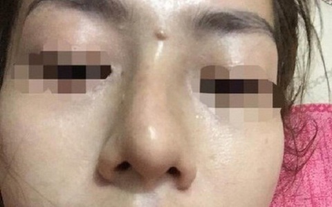Nữ bệnh nhân bị mù mắt sau tiêm filler, bác sĩ cảnh báo: Cẩn trọng những spa "chào giá" bèo nhất thị trường