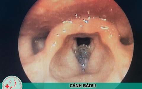 Ăn ốc len xào dừa, một bệnh nhân nhập viện khẩn cấp do khó thở