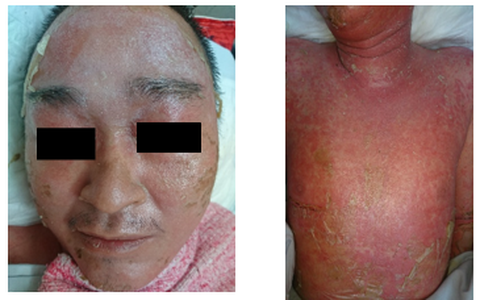 Tự điều trị bằng thuốc nam, bệnh nhân nhập viện trong tình trạng toàn thân phát vảy nến mủ